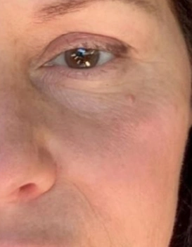 Close-up of a woman's eye and cheek, showing under-eye texture, fine lines, and natural skin - skincare/anti-aging focus