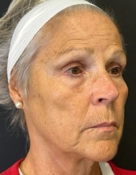 Elderly woman side-profile with headband showing facial aging, wrinkles, sunspots and sagging skin for skincare/derm