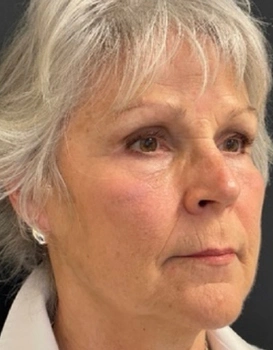 Close-up profile portrait of an older woman with gray hair and stud earring, neutral expression