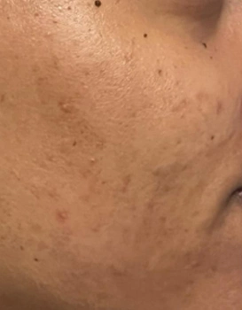 Close-up of a person's cheek showing acne scars, enlarged pores and uneven skin texture on brown skin